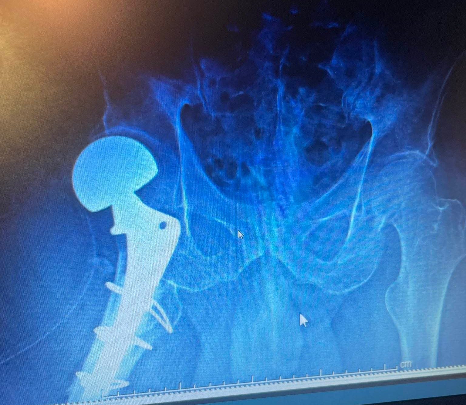 Odd hip replacement technique